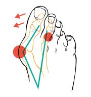 Korekcyjne skarpetki tapingowe na paluch koślawy Compressana TAPE SOX Hallux valgus